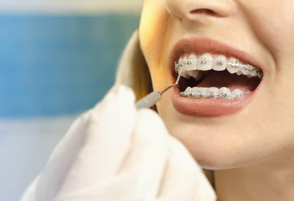 a closeup of an orthodontist performing a braces checkup