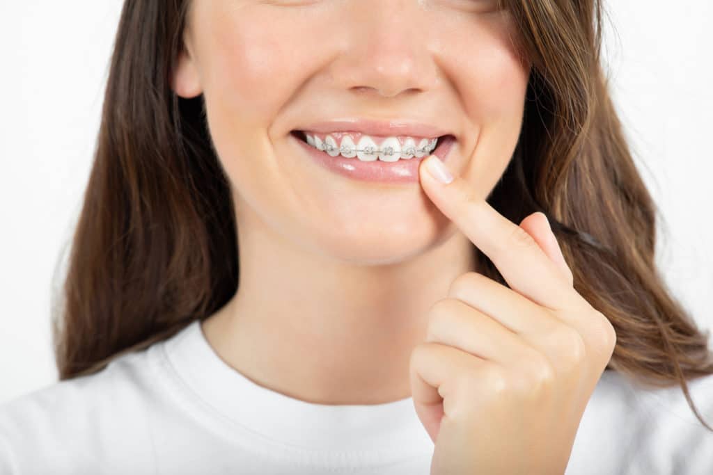 a woman pointing to her clear braces