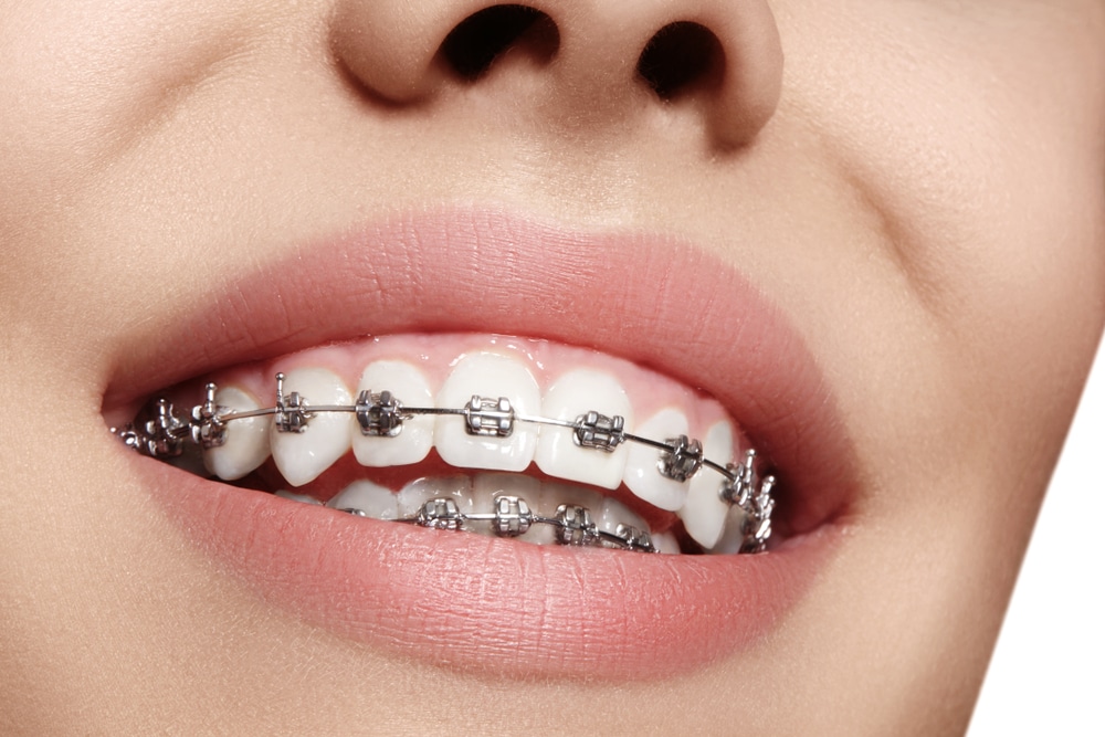 close up of traditional metal braces on a patient