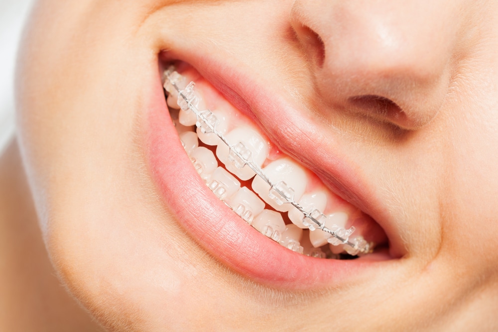 a close up of clear ceramic braces on a patient