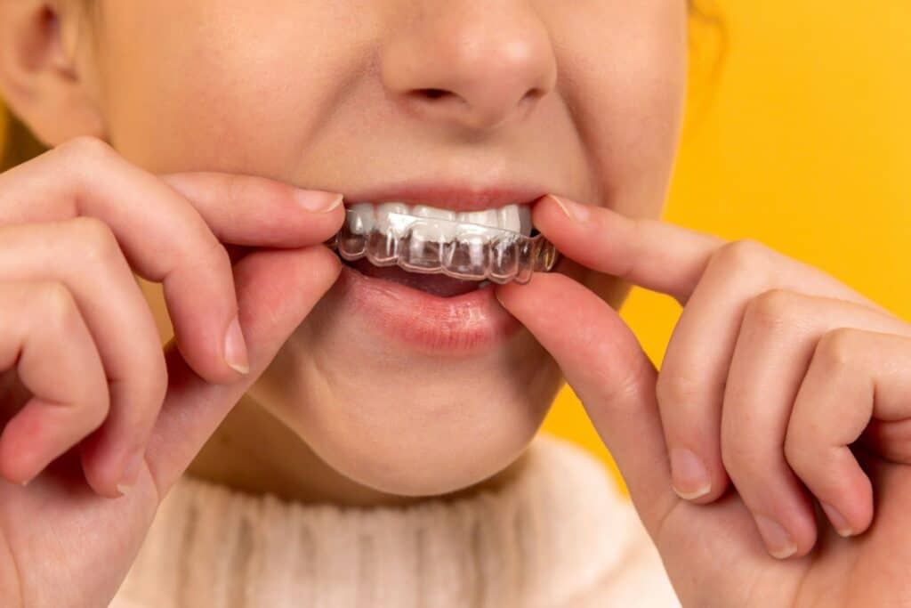 Teen with Invisalign Teen® in Dayton, Ohio inserting her upper invisalign tray.