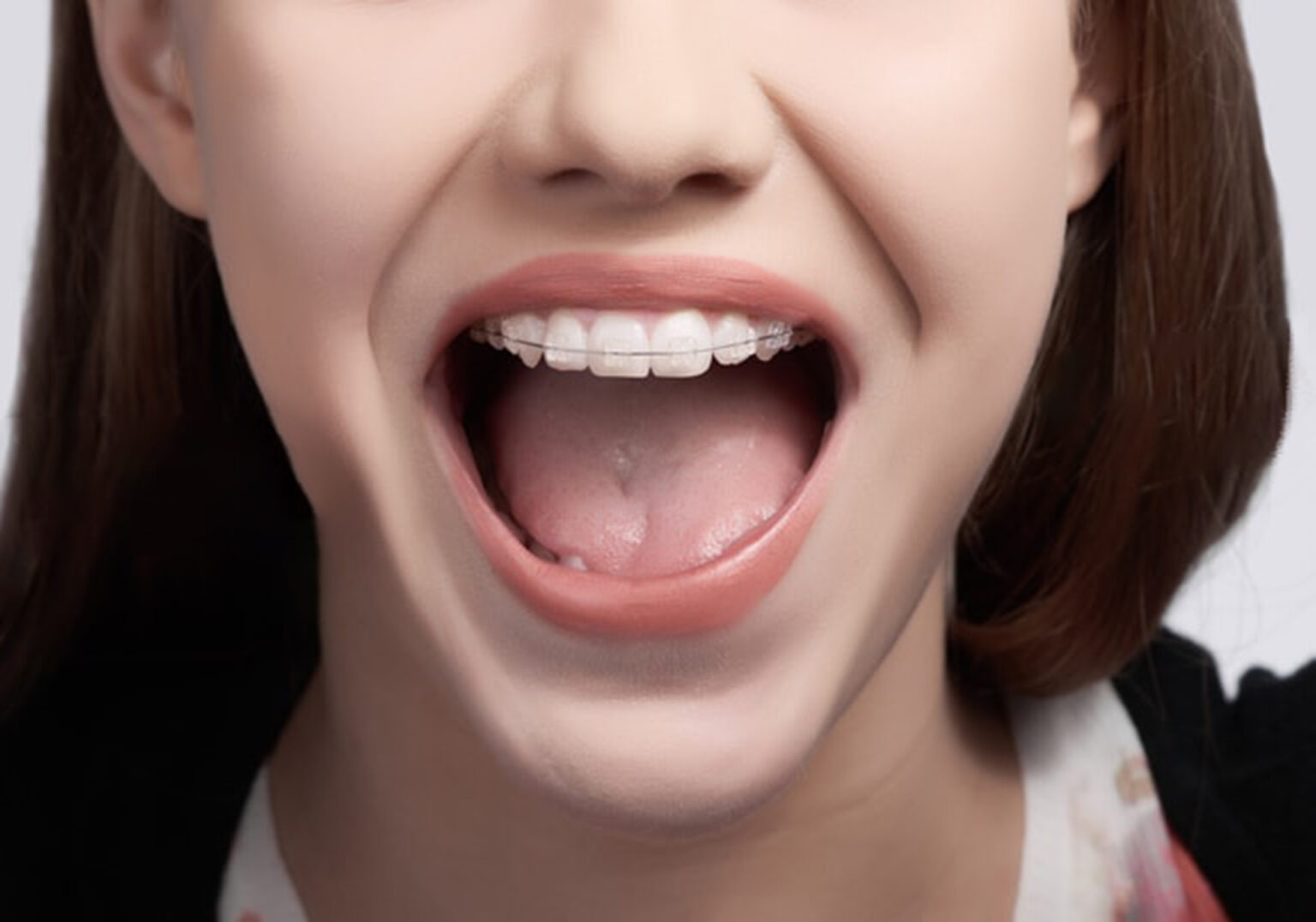 Close up of a young woman with clear braces in Bellefontaine, Ohio smiling